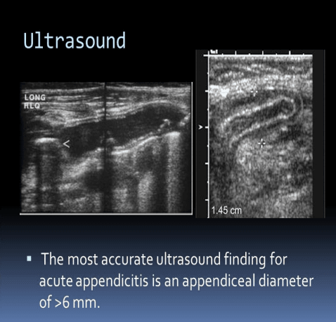 Reproductive Aspects of Acute Appendicitis Reproductive Aspects of Acute Appendicitis